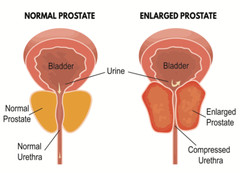 kidney cleanse – PROSTATE SUPPORT Advanced Complex -3 B- saw palmetto extract